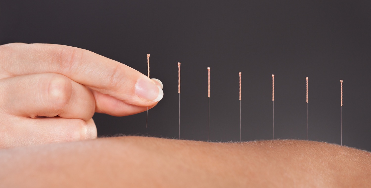 acupuncture pic